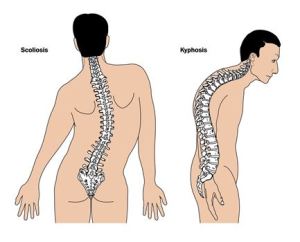 Diagram showing kyphosis and scoliosis, two types of spinal curvature